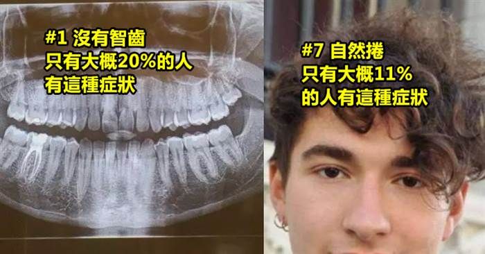 盤點12種只有被上帝眷顧才會擁有的「超罕見身體特徵」！#1 沒有智齒