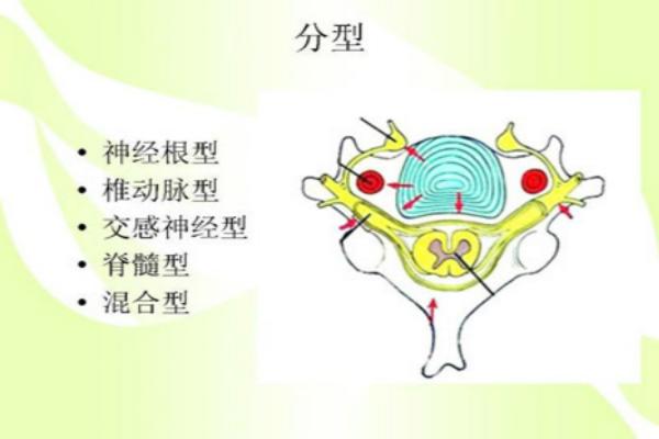 我的心慌原來是頸椎病造成的交感神經型頸椎病