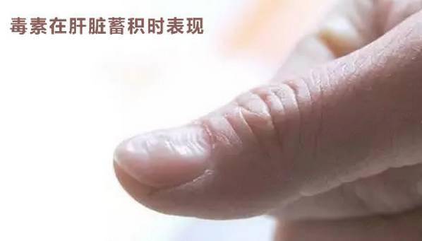 肝髒藏毒太深時，身體就會出現6大提示信號！