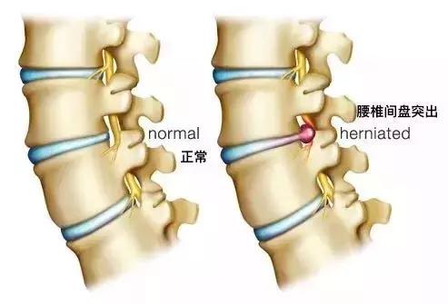 腰椎間盤突出不用慌，只要做到這一點，突出了也不腰疼！