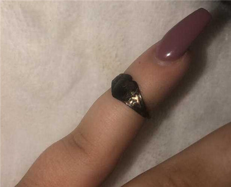 不可思議！20歲女子打噴嚏時噴出戒指 系12年前丟失