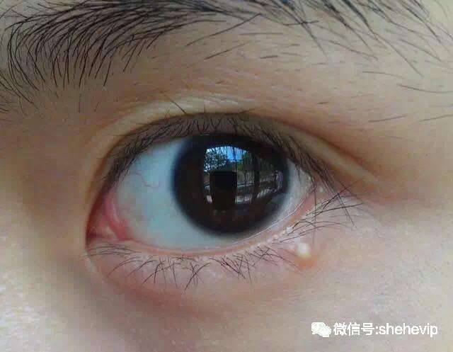 臉上長出了「脂肪粒」不要用手擠，小心被感染！教你「5招」輕鬆去除！！