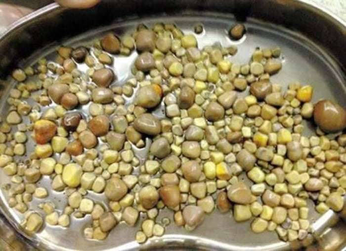 醫生從男子體內夾出「420顆腎結石」震驚全國！醫生夾到手軟：因為他太愛吃這個...