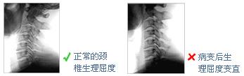 頸椎病傷在全身！最笨的辦法，不動脖子，兩招就搞定！