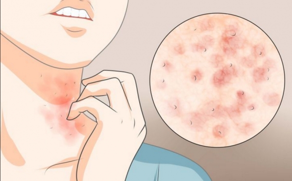 皮膚過敏發癢好不了？中醫師：先戒除「這食物」再說！