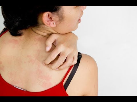 皮膚過敏發癢好不了？中醫師：先戒除「這食物」再說！
