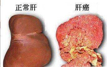 肝病化療也沒用？這3種東西常吃，修復肝細胞見效快，預防肝炎、肝硬化