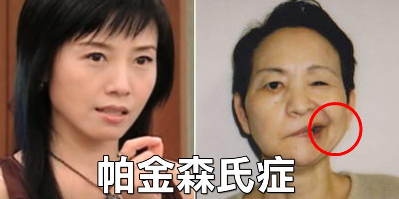 「方岑」驚罹「帕金森氏症」退出演藝圈，發病前「十大早期徵兆」須當心，無法根治的腦退化真相！