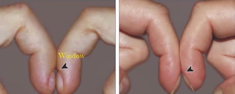 測血糖發現「手指不一樣」！「老菸槍」照X光已是肺癌末期，最終不幸病逝！醫師：「一個測指動作可自救～」 