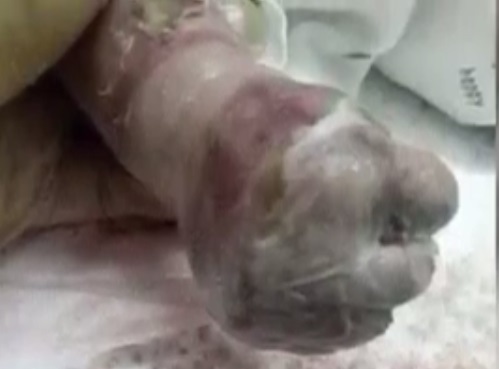 驚呆！新生兒雙腿雙腳「無皮膚」，猶如「透明寶寶」，父母被嚇到腿軟了！ 