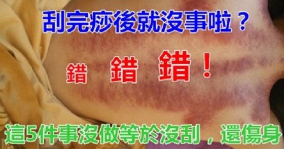 刮完痧就沒事了？錯錯錯！中醫師叮嚀：５件事沒做等於沒刮、超傷身 