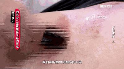 感冒、咳嗽、高燒，這樣刮一刮，就完事！收了吧！