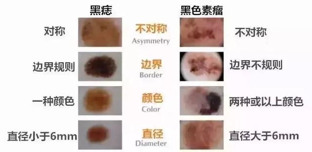 「痣」的直徑超這個數可能是瘤！5招教你辨別痣和瘤