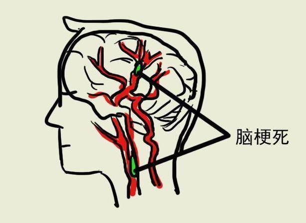 睡覺時，有這種表現就是中風前兆！一定要警惕哦！ !