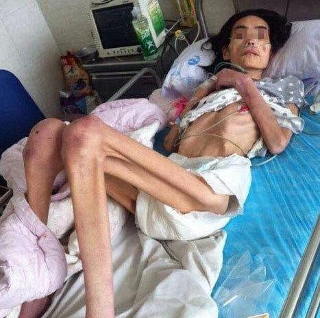 為了維護出軌兒子，婆婆將漂亮兒媳，虐待餓成40斤骷髏...！原本模樣長得很美阿...可憐