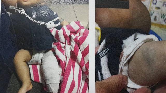 「真讓人心疼！」男嬰遭父親扭斷四肢 傷口縫合不哭鬧 護理師：痛習慣了 