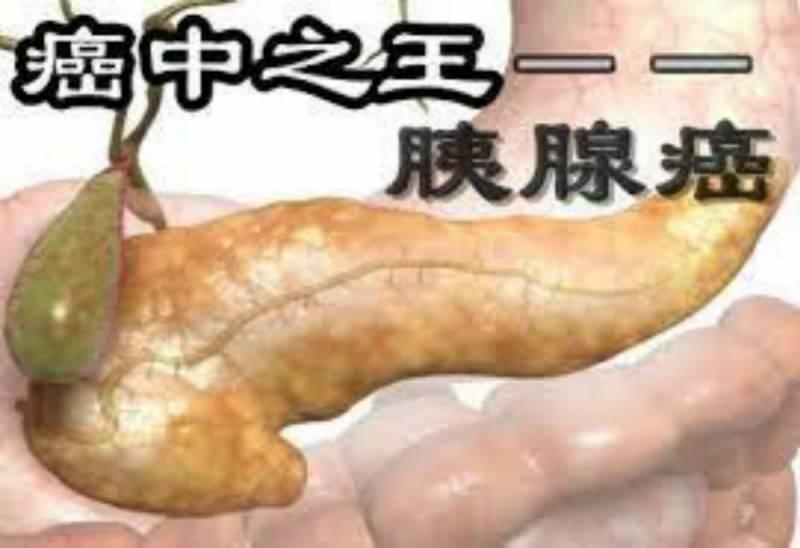 癌中之王－幾個壞習慣導致胰腺癌