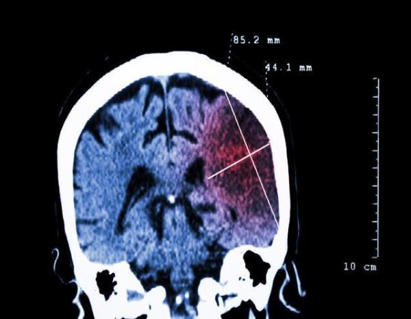 腦梗塞的病因，終於被揪出來了！這3個「禍源」最好遠離