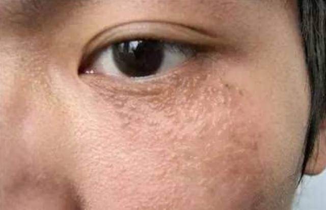 臉上長脂肪粒不要用手擠，教你3個小妙招，就能快速去除脂肪粒！ !