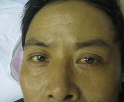 別忽視！「肝癌」的8種徵兆你一定要知道 ! 晚看了後悔一輩子！！ 