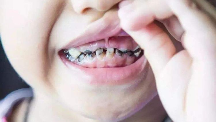 4歲女童一嘴小黑牙，兒科醫生：不是因為糖，而是家長的這種行為
