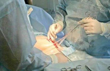 妻子難產，丈夫果斷保大人，婆婆執意保孩子，醫生出來後全家蒙住