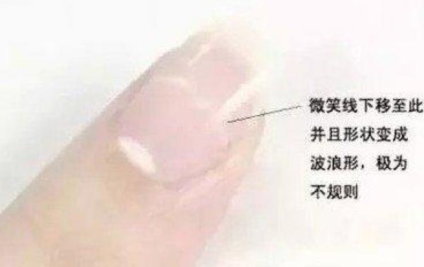 從手指甲就可以看出一個人的健康！你知道指甲上一條一條的橫紋縱紋代表什麼意思嗎？