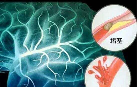 為什麼「中風」越來越多？醫生奉勸：3種食物別吃，會「加速」血管堵塞，再喜歡也要忌口