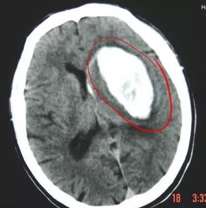 為什麼「中風」越來越多？醫生奉勸：3種食物別吃，會「加速」血管堵塞，再喜歡也要忌口
