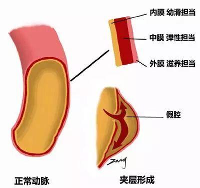 52歲男子，背痛一天，驟然離世，醫生措手不及，這病真的太兇險