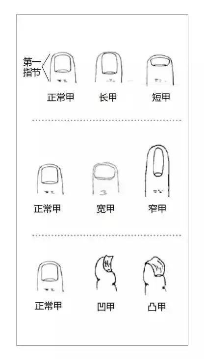 健康指甲全圖鑑：指甲長成這樣，要小心疾病找上門！ -