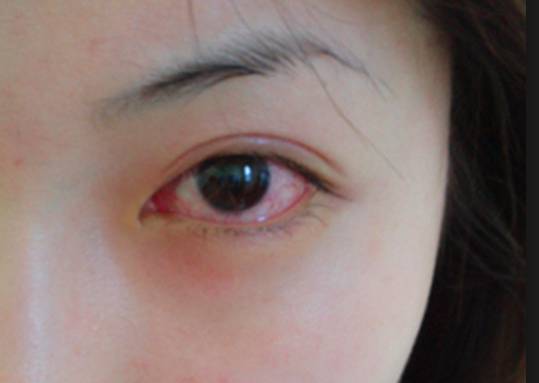 眼睛「乾乾」的，別以為是小事....大病來臨前，身體給你14個預兆！！再不注意來不及了