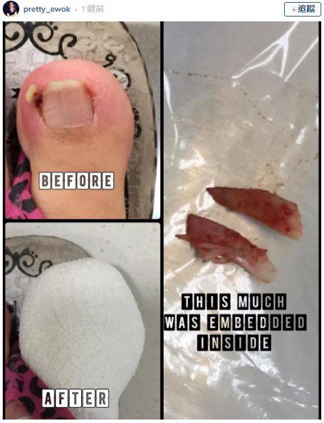 17個會讓人覺得超噁爛的「腳指甲知識」　人類的腳指甲其實是爪子
