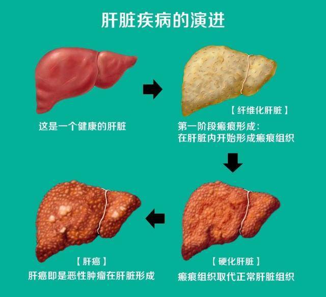 肝不好，除了指甲，這4個地方也會有變化！醫生推薦5個養肝小方法