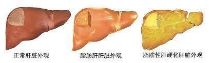 肝不好，除了指甲，這4個地方也會有變化！醫生推薦5個養肝小方法