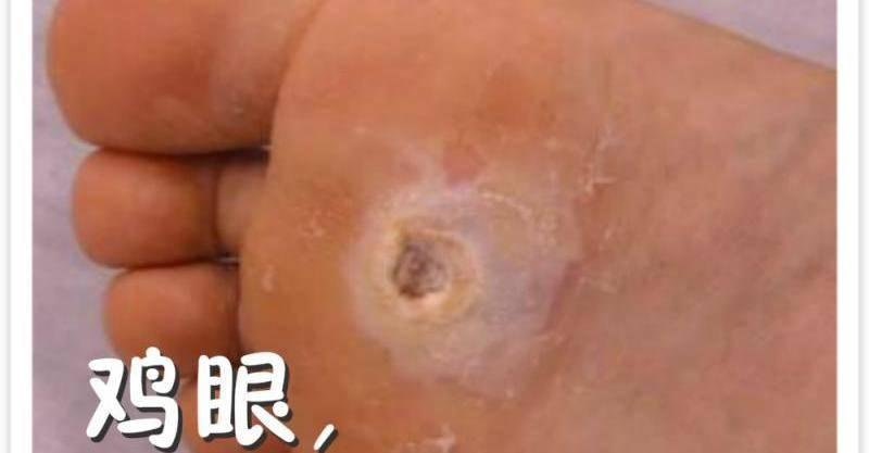 明燈醫學：雞眼，用熱豬油一抹就好，效果都非常明顯，對皮膚還沒有傷害。