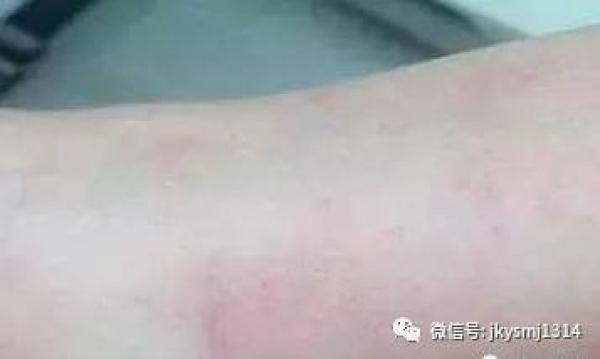 再不注意這6個信號！你的血管就要堵了！ 