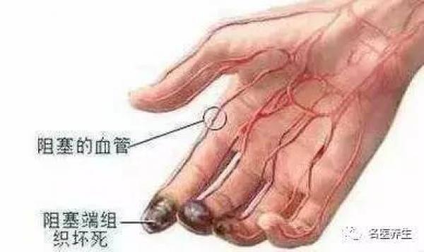 再不注意這6個信號！你的血管就要堵了！ 