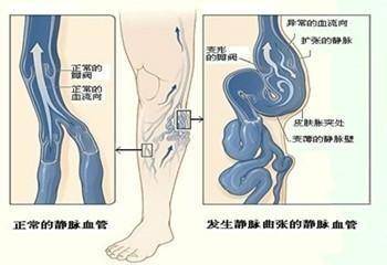 靜脈曲張一定要手術嗎？送你一個千金難買的中醫秘方 -