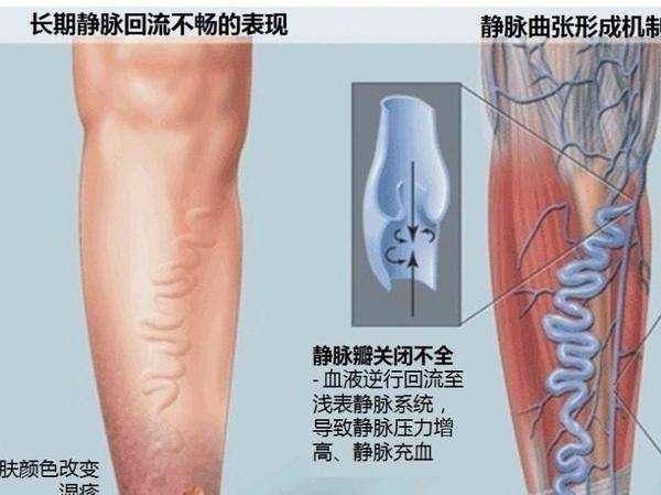 靜脈曲張一定要手術嗎？送你一個千金難買的中醫秘方 -