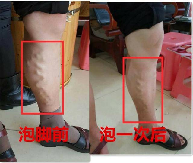 靜脈曲張一定要手術嗎？送你一個千金難買的中醫秘方 -