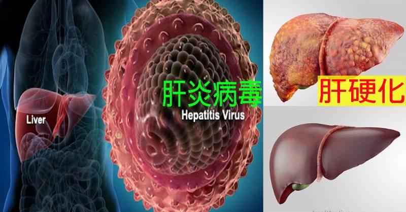 七成民眾肝病不自知，兩年內死亡率高達300％！一秒自測「12種早期徵兆」莫輕忽!!
