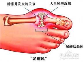痛風為何從腳起？該怎樣預防和緩解？