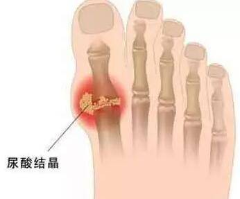 痛風為何從腳起？該怎樣預防和緩解？