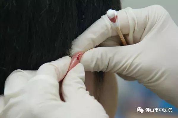 耳朵裡的養生秘密！這5套耳穴操不僅防病還能美容 
