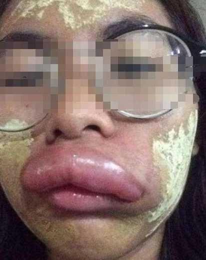 泰國女孩嫁中國小夥，新婚激戰後....第二天變「香腸嘴」，醫生的話讓他們很尷尬 