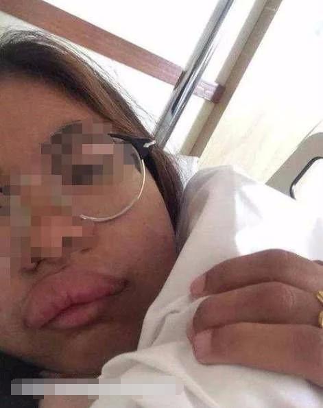 泰國女孩嫁中國小夥，新婚激戰後....第二天變「香腸嘴」，醫生的話讓他們很尷尬 