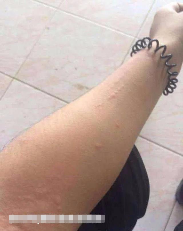 泰國女孩嫁中國小夥，新婚激戰後....第二天變「香腸嘴」，醫生的話讓他們很尷尬 