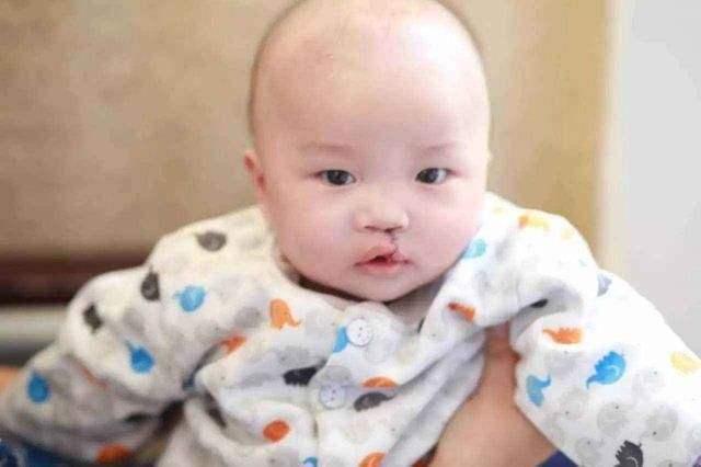 產檢胎兒是兔唇，媽媽堅持把他生下，幾個月後孩子變化令人驚喜