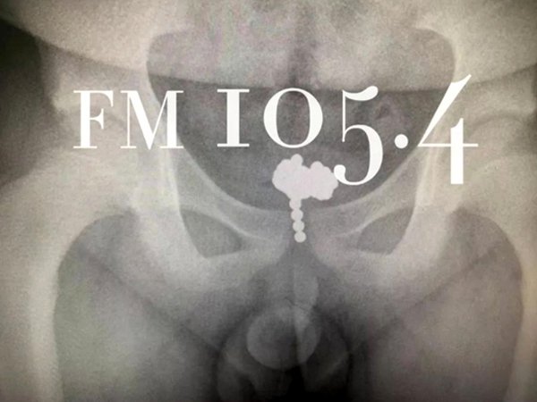 70顆磁珠塞進下體 11歲男童：尿尿特別痛！